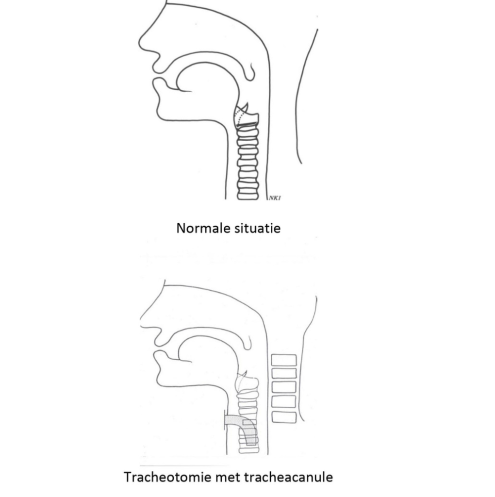 Tracheotomie met tracheacanule