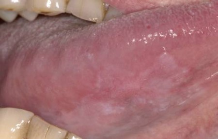 humaan papillomavirus keel symptomen